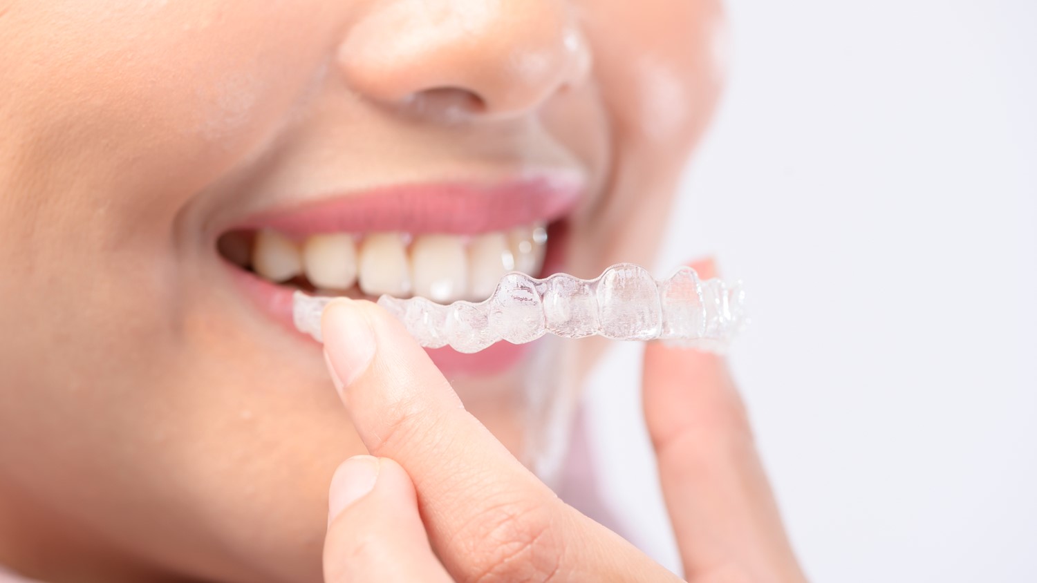 Invisible Aligners